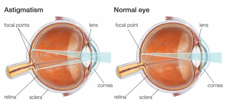 astigmatism vizual 5